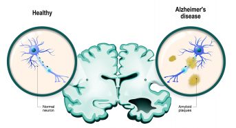 alzheimers disease